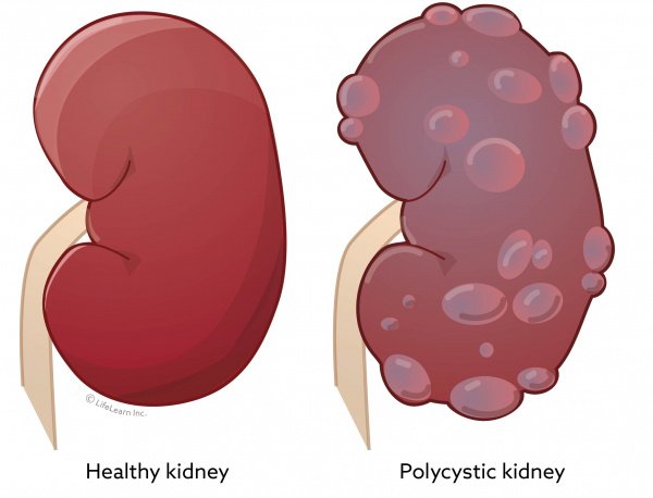 Maine Coon Polycystic Kidney Disease: Kidney comparison